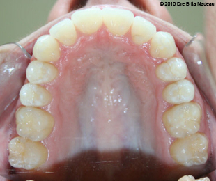 Marie-Hélène Cyr - Upper occlusal view - After orthodontic treatments and orthognathic surgeries (January 29, 2010)